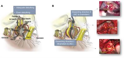 Preservation of the integrity of facial nerve in vestibular schwannoma microsurgery: A consecutive study of 127 clinical cases focusing on nervus intermedius